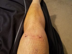 knee shot
